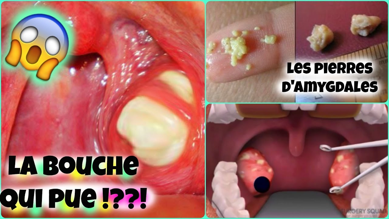 LA BOUCHE QUI PUE| Les pierres d'amygdales | COMMENT S'EN DEBARRASSER