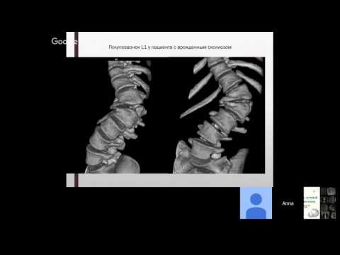 Формирование правильной осанке дошкольников Гимнастика кифоз видео