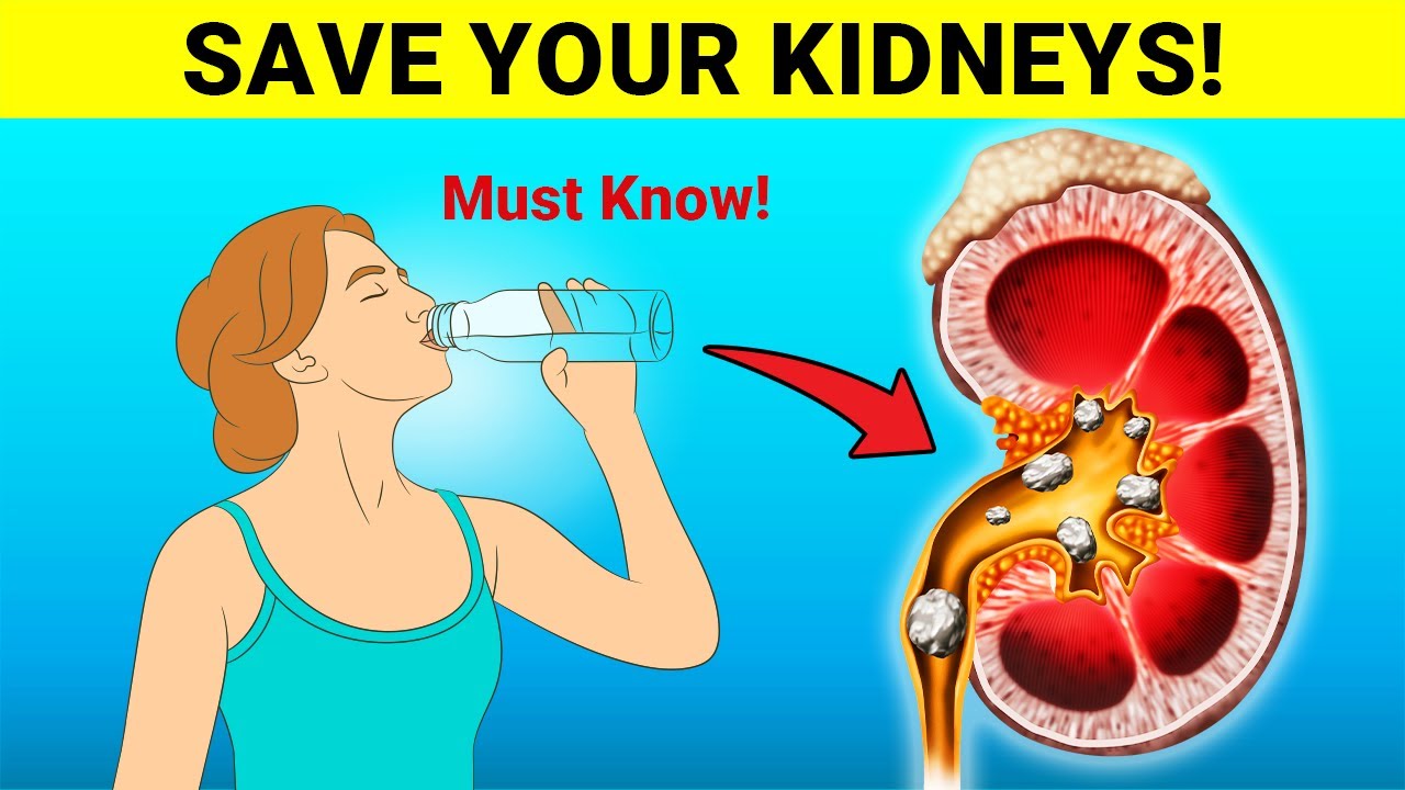 Top 8 Habits To Heal Your Kidneys and Prevent Kidney Stones