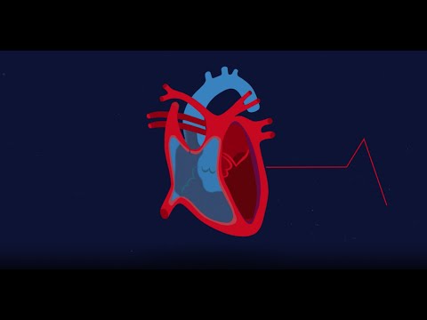 Understanding Hypertrophic Cardiomyopathy (HCM)
