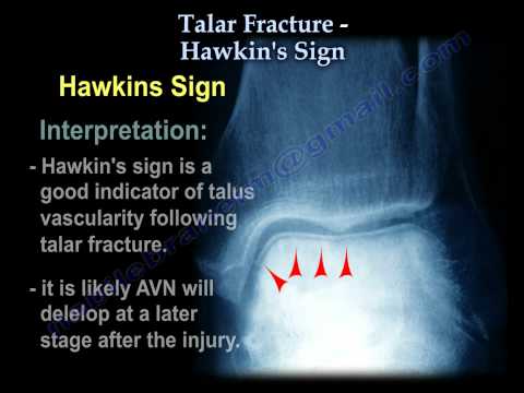 Talus Fracture , Hawkin's Sign - Everything You Need To Know - Dr. Nabil Ebraheim