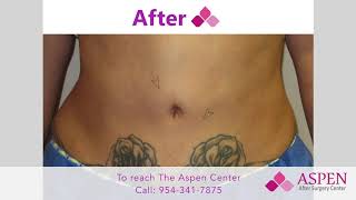 Aspen After Surgery : After Liposuction Hard Knots and Contour Irregularity Occurred