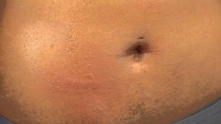 Red, Pimple-Like Bumps on Stomach : All-Natural Care