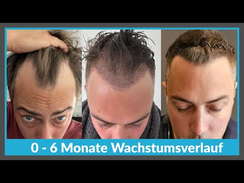 The first 6 MONTHS after a hair transplant: How THICK should it be?