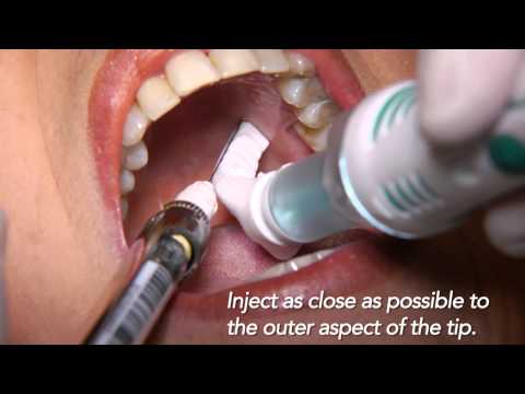 DentalVibe Clinical Applications