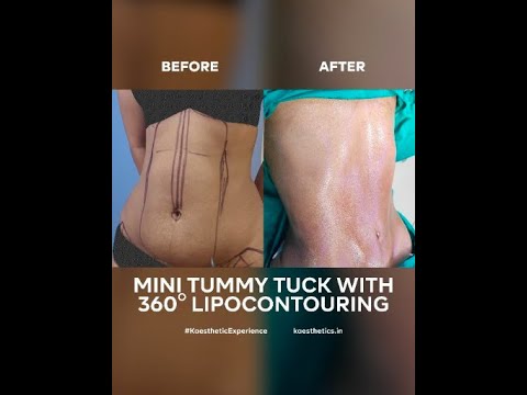 Before and After of Mini Tummy Tuck with 360 degree Lipocontouring #shorts