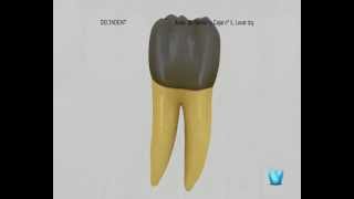 Periodontitis. Delta Dent. Implantes dentales en Madrid. - Clínica Dental Delta Dent