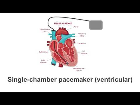 image-Who makes the best pacemakers? 