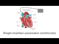 Pacemaker Varieties: Single to Biventricular Explained