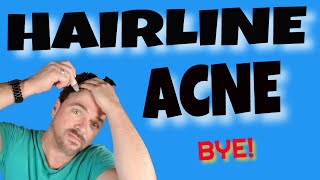 Cure Hairline Acne Pimples FAST! | CHRIS GIBSON