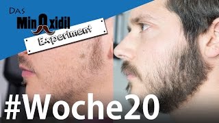 Das Minoxidil Experiment #Woche20  Fortschritte, Highlights und Fails