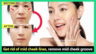 Mid Face Lift | Get rid of mid cheek lines, remove midface wrinkles with Face exercise & massage