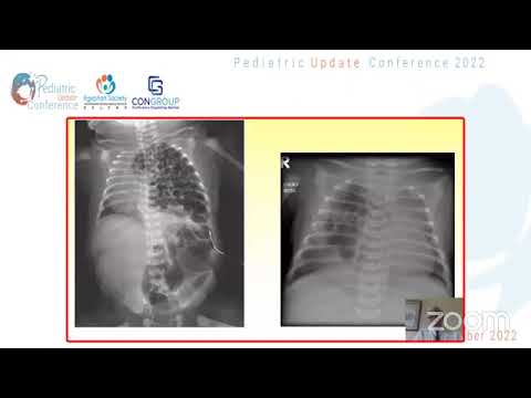 Approach to Respiratory Distress Prof Rube Alvaro