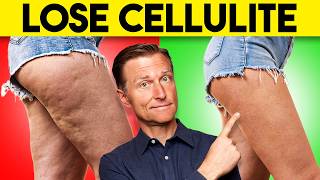 Get Rid Of Cellulite On Hips & Glutes (For Good)