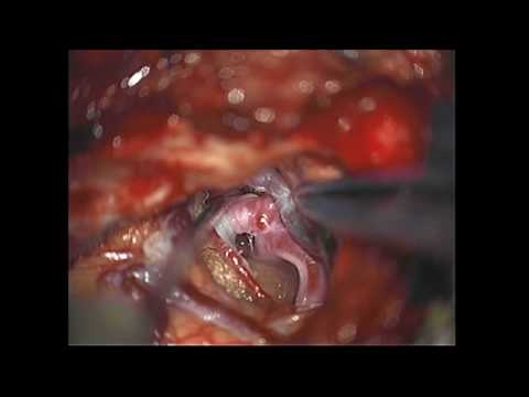 Operacja tętniaka mózgu