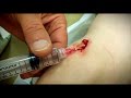 STITCHES Cleaning Numbing Suturing The Wound Dr Paul