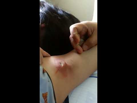 Capsules para sa mabilis na pagbaba ng timbang Kung paano mapupuksa ang cellulite sa mga binti at ang papa review