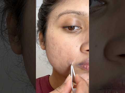 Pimple patch #pimplepatch #acnepatch #acneskin #acneproneskin