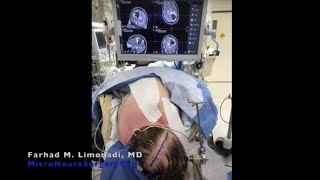 Arteriovenous Malformation (AVM) Resection after presenting with brain hemorrhage. Left Parietal AVM