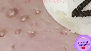 Download Lagu relax,Satisfying,nose blackheads,tweezers,acne treatment,#blackheadremoval #acnetreatment Thumbnail