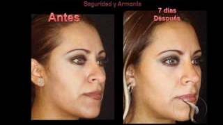 preview picture of video 'Rinoplastia Dr Jose Daza Mexico City Aesthetic Rhinoplasty'