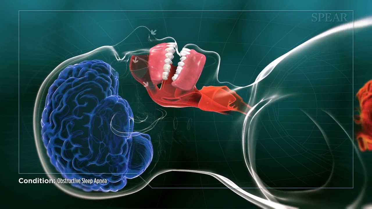 Obstructive Sleep Apnea