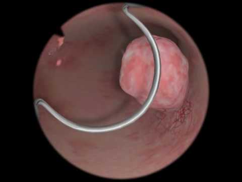 , title : 'Polypectomy / Polyp Removal - Virtual Reality Simulation for Endoscopic Surgery'