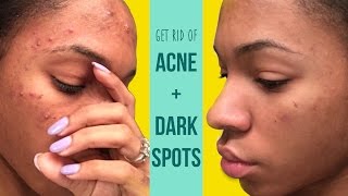 How I Get Rid of Acne and Fade Dark Spots! ▸ VICKYLOGAN