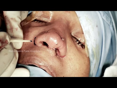 Getting A Difficult Nose Job At Richardsons