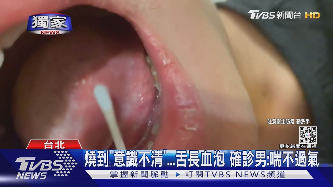 燒到「意識不清」舌長血泡 確診男:喘不過氣