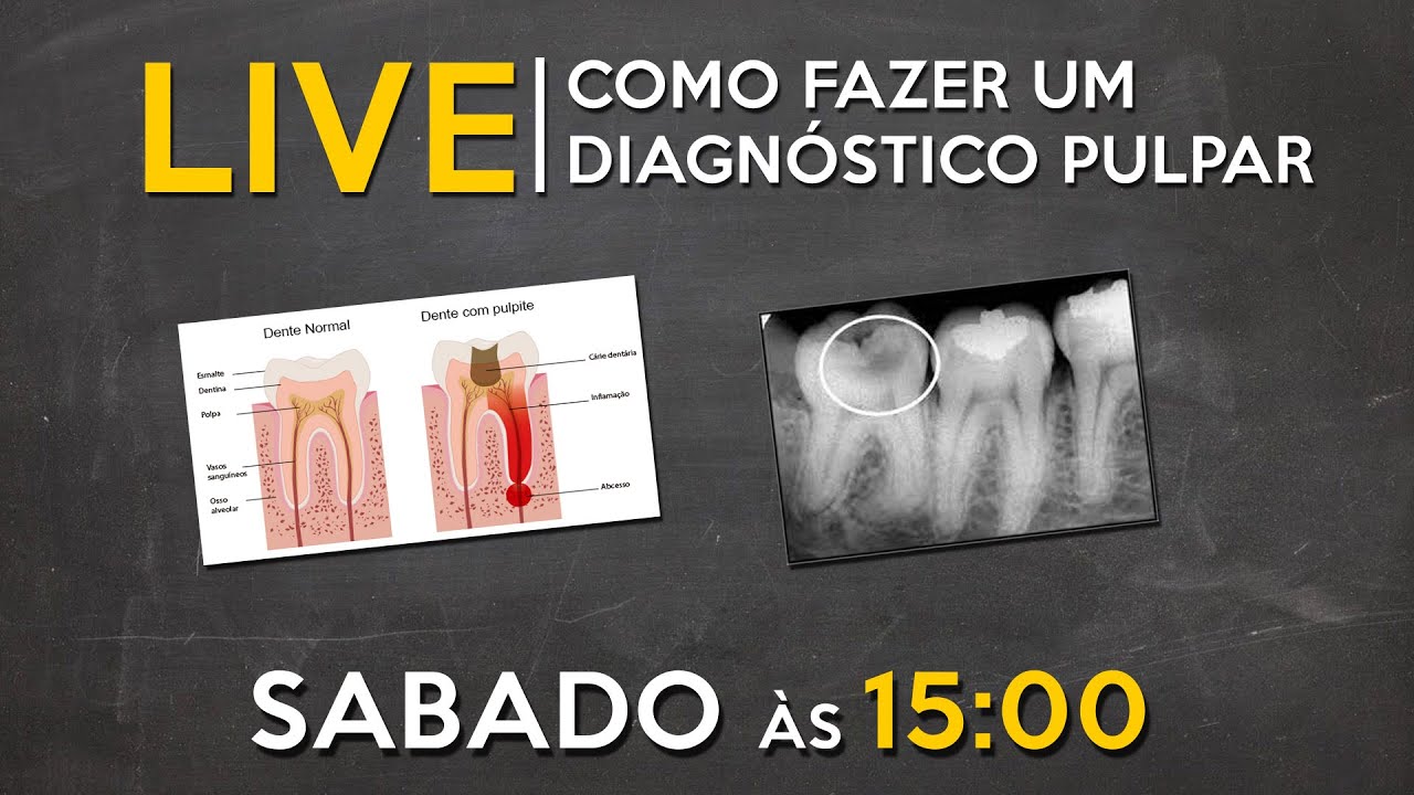 LIVE #032 - Como fazer um diagnóstico pulpar?