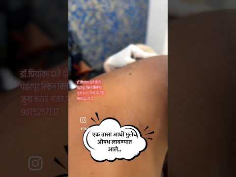 Wart removal procedure