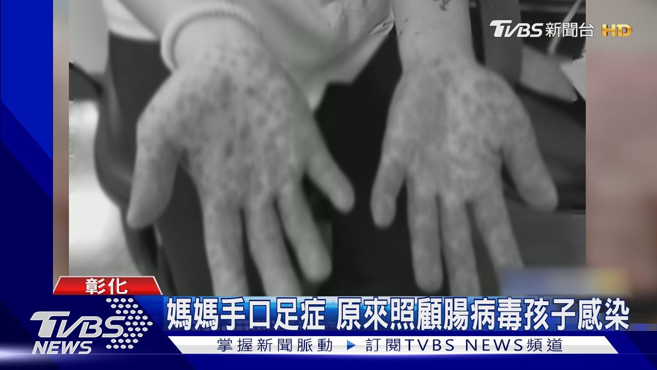 媽媽手口足症 原來照顧腸病毒孩子感染