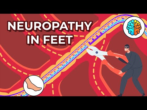 Dealing with Neuropathy in Feet: Causes, Symptoms, and Treatments