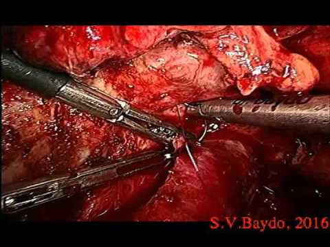 Injury Of Superior Mesenteric Vein During Laparoscopic Pancreatectomy