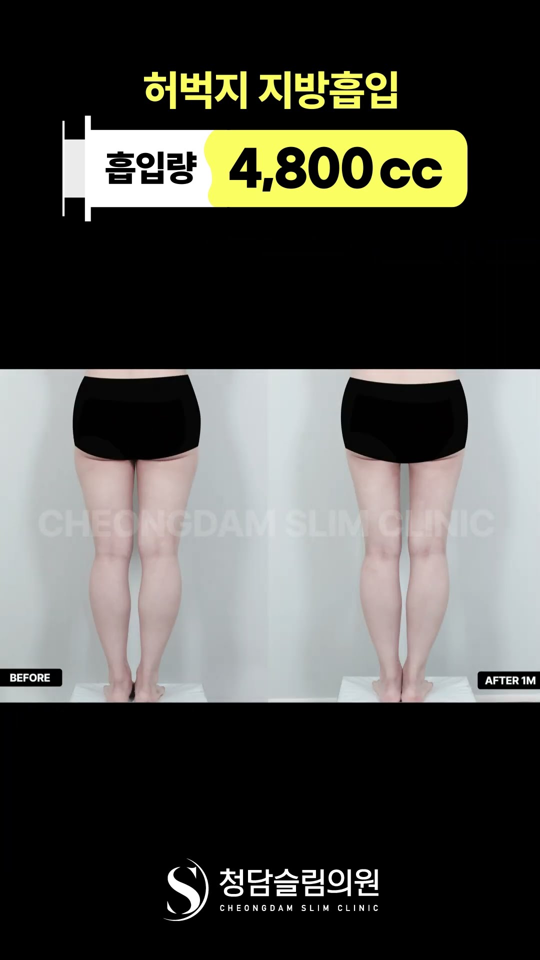 “허벅지 실루엣, 허벅지 틈..이 정도까지 차이 남?”