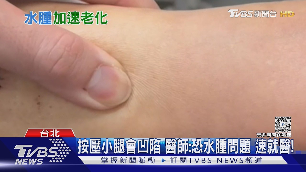 影片/水腫不是變胖!醫揭心.肝.腎警訊 出現「這症狀」勿輕忽