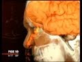 Man's Brain Fluid Leaking Through 'Chronic Runny Nose'