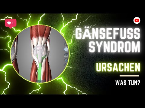 Knieschmerzen. Gänsefusssyndrom oder Pes Anserinus. Die Ursachen.