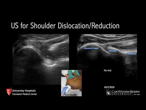Ultrasound for Shoulder Dislocation/Reduction