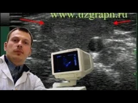 Pediatric Soft tissue ultrasound - Neck lymphangioma