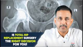 Is Hip Replacement Right for You? * DECIDING ON TOTAL HIP REPLACEMENT SURGERY *