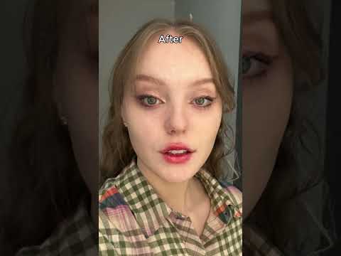 Stunning V-Line Surgery Before & After | ID Hospital, Seoul Korea