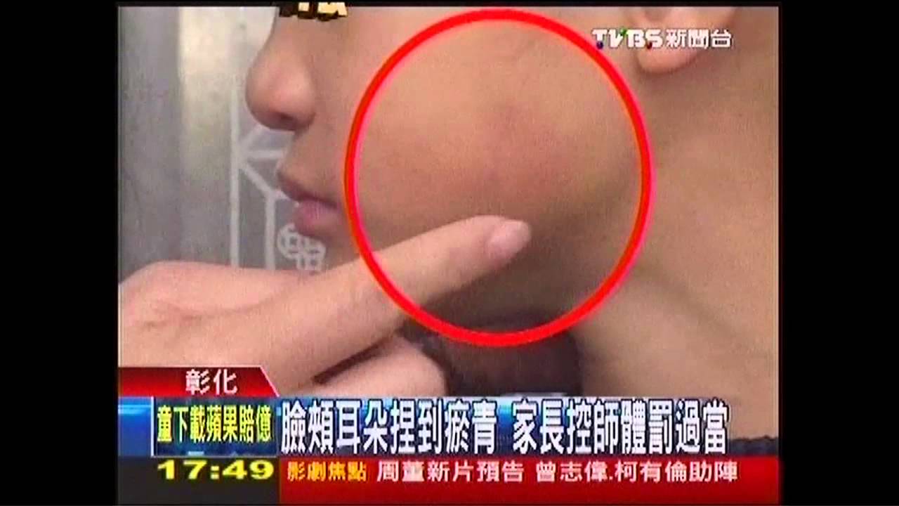 臉頰耳朵捏到瘀青 家長控師體罰過當