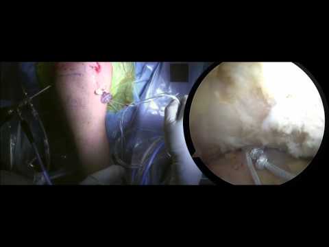 AC Joint Reconstruction | Shoulder Arthroscopy