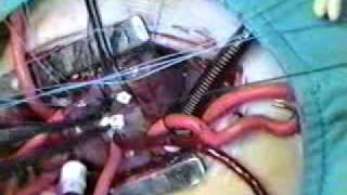 Ventricular Septal Defect (VSD)