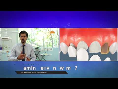 Laminate veneer nedir? - Dr. Abdullah Uysal