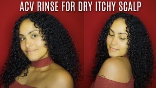 Apple Cider Vinegar Rinse For Dry Itchy Scalp | IT BURNED MY SKIN!