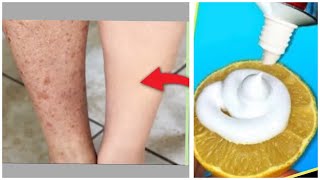 How to get rid of Dark spots, Scar,  Hyperpigmentation on legs fast