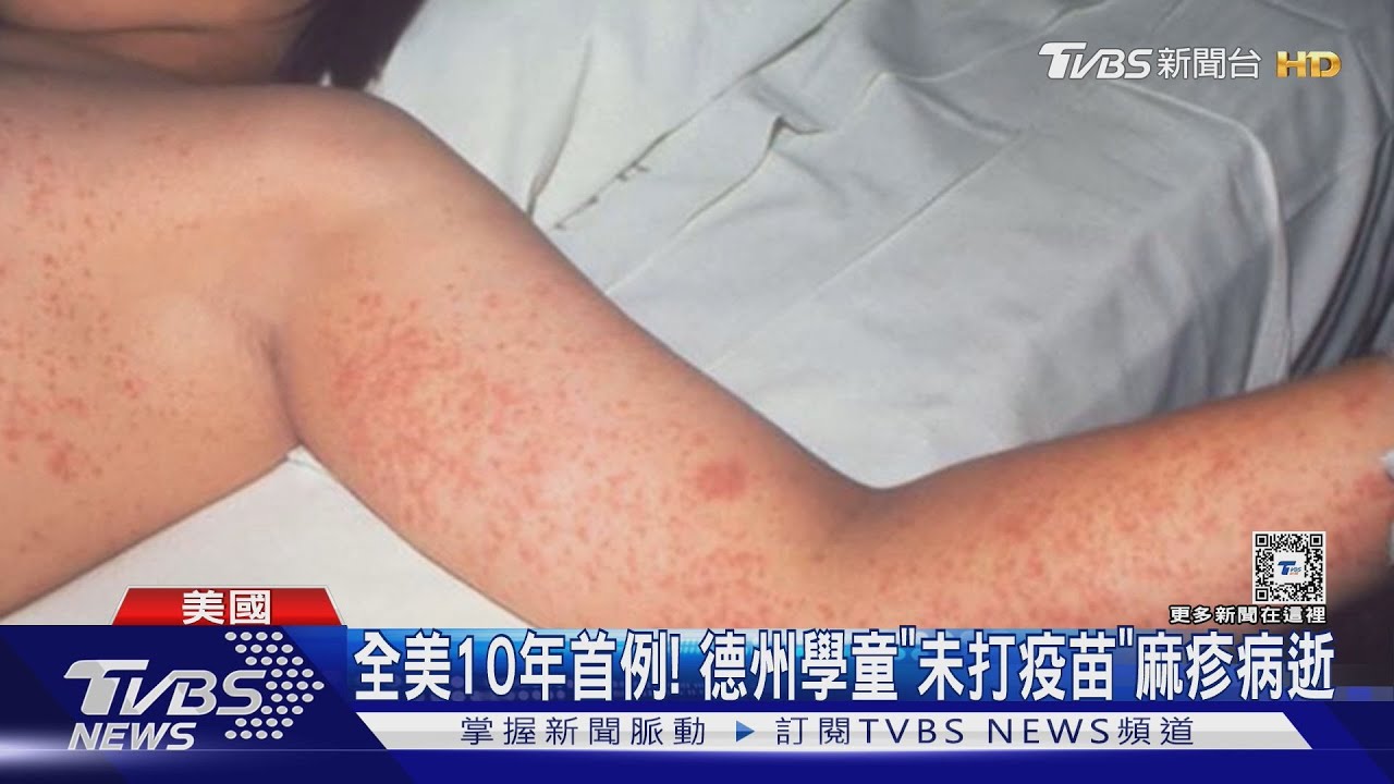 全美10年首例! 德州學童「未打疫苗」麻疹病逝